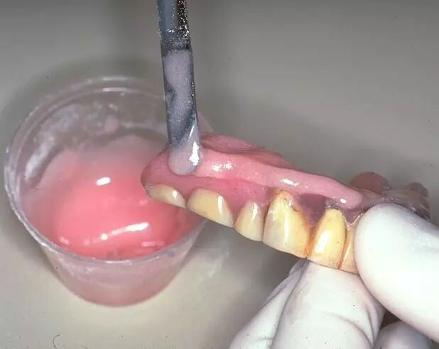 牙科材料硅胶怎么用软衬材料的应用及操作案例_https://www.jmylbn.com_新闻资讯_第10张