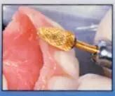 牙科材料硅胶怎么用软衬材料的应用及操作案例_https://www.jmylbn.com_新闻资讯_第14张