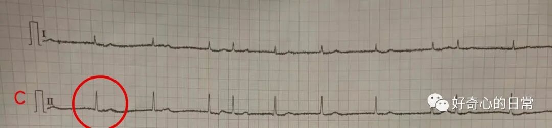 为什么要用推注泵临床基础知识系列（1）-高钾血症的碎碎念_https://www.jmylbn.com_新闻资讯_第6张
