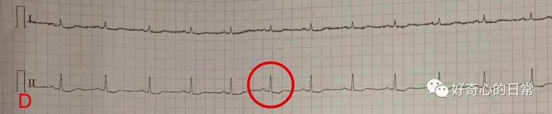为什么要用推注泵临床基础知识系列（1）-高钾血症的碎碎念_https://www.jmylbn.com_新闻资讯_第9张