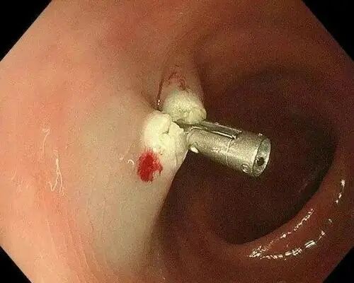 内镜夹怎么不掉医生切完息肉竟把“夹子”落在了肚子里？别慌！听听专家怎么说_https://www.jmylbn.com_新闻资讯_第9张