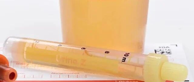 ​预防肾衰竭，降蛋白这2点肾友必须要谨慎，以免走弯路