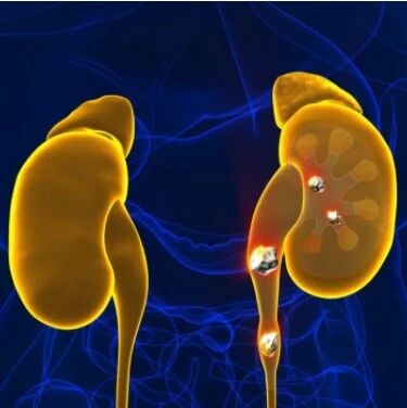 注意：更重视降肌酐的是这4类肾病需要