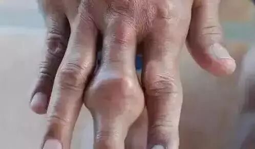 痛风病情恶化的 4 大征兆,一定要小心!