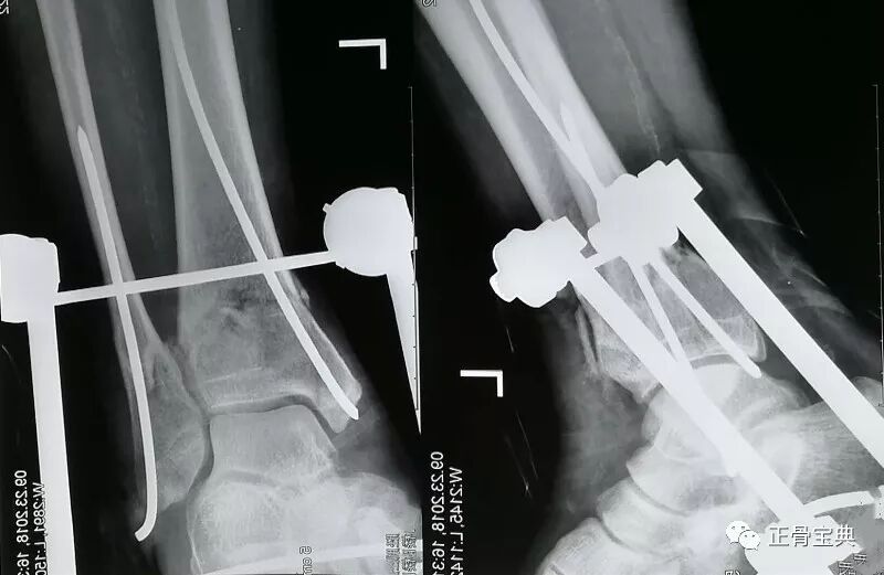 正骨宝典 035 胫腓骨远端骨折 刘清春微创骨针01 正骨宝典 微信公众号文章阅读 Wemp