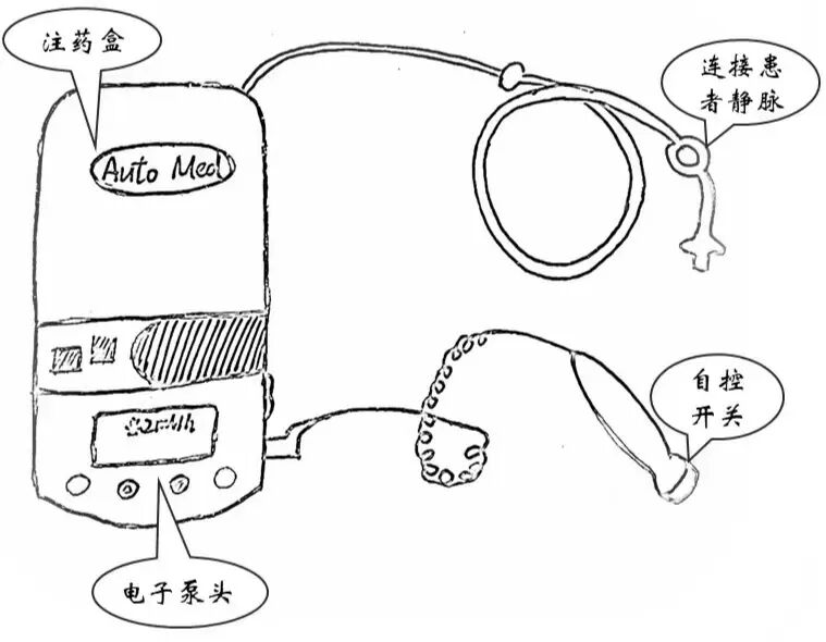 麻醉什么泵“术后镇痛”知多少？麻醉医生带您了解术后镇痛泵！_https://www.jmylbn.com_新闻资讯_第1张