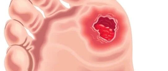 每2个糖尿病足患者就有一人要截肢是危言耸听么？警惕那些导致截肢的小小“导火索”