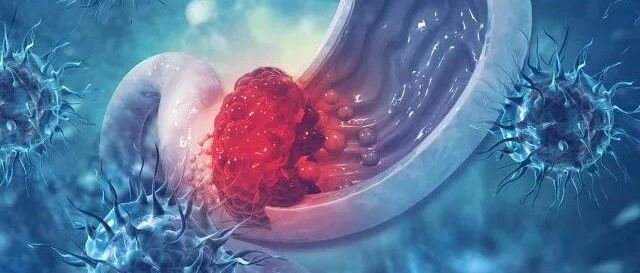 早期胃癌真的完全没有症状吗？