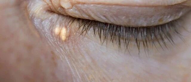 身体出现“黄色瘤”要警惕！这些蛛丝马迹说明血脂异常了！