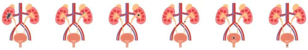石头发飙，痛不欲生？揭秘尿路结石的快速缓解妙招→
