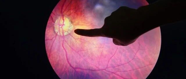 糖尿病患者，你的眼底还好吗？