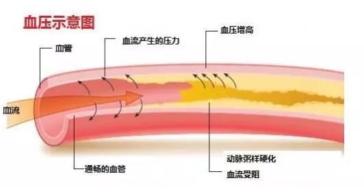 出現這些症狀時，無論多忙您都要立刻量一量血壓 健康 第2張