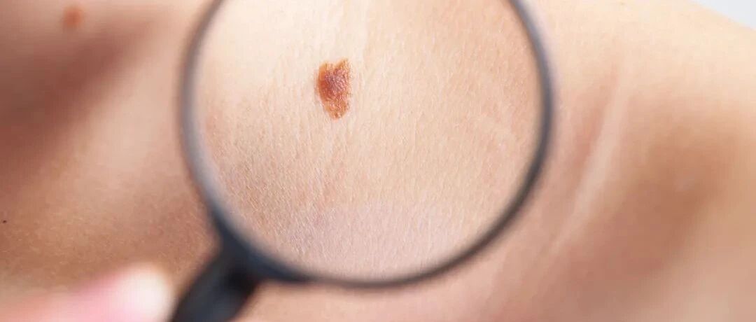 如何判断痣的“好坏”？哪些痣更容易发生癌变？