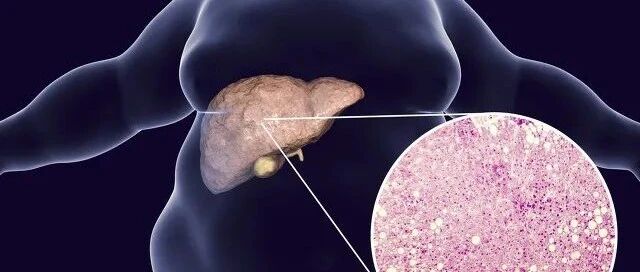 脂肪肝会影响机体的免疫功能，诱发多种疾病！