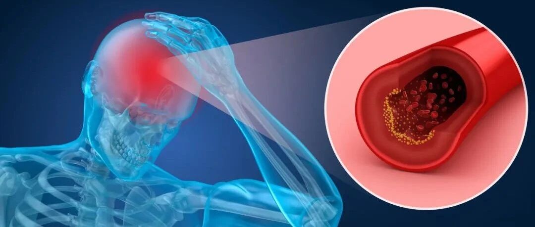 经常心慌竟是脑梗先兆？有这些高危因素的人一定要注意！