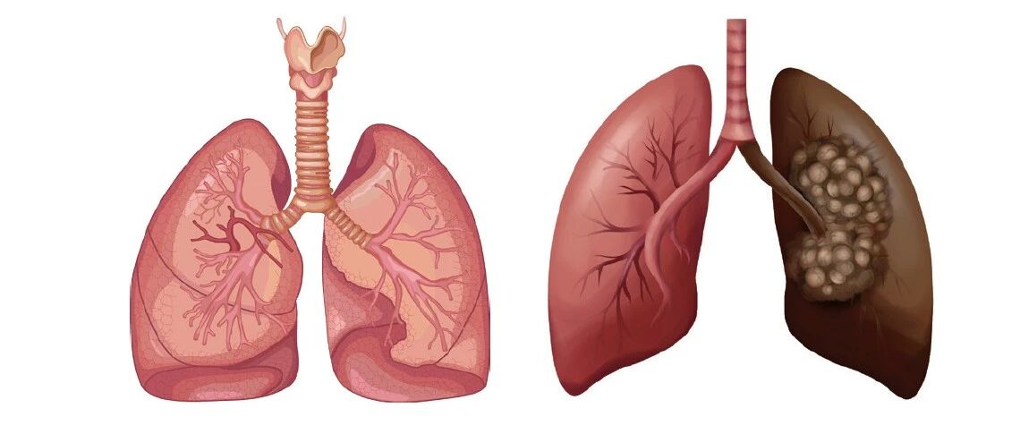 和您说说关于肺癌防治的肺腑之言