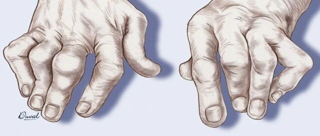 起病急，夜间因剧痛而惊醒：痛风，来去如风，痛不欲生