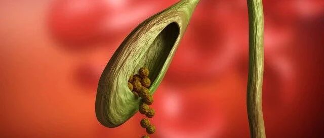 胆结石病“重女轻男”，有了这些表现时您得警惕啦！