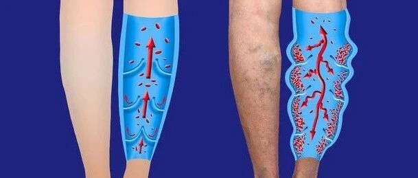 长期站立工作者,警惕静脉曲张