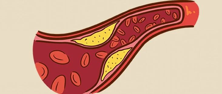 高黏血症是什么病？血液像浆糊，这该如何是好