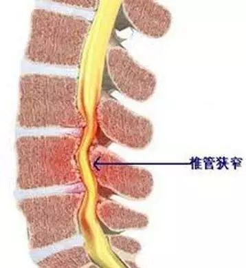 下肢忽然疼痛腫脹不要自行按摩，引發深靜脈血栓脫落則非常危險 健康 第7張