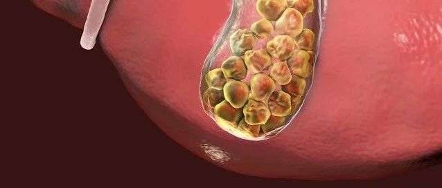 大便忽然变成白陶土色？警惕胆结石！