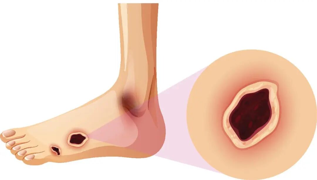 为什么糖尿病不能震动【广大糖友的福音！】糖尿病周围神经病变筛查之震动感觉阈值检测_https://www.jmylbn.com_新闻资讯_第5张