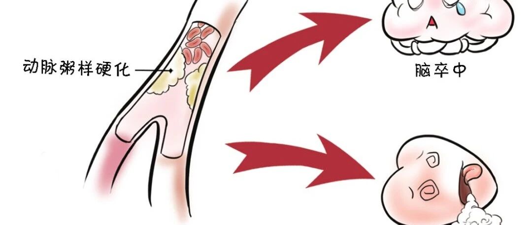 90％的脑卒中风险归因于10个可控危险因素，对，可控！