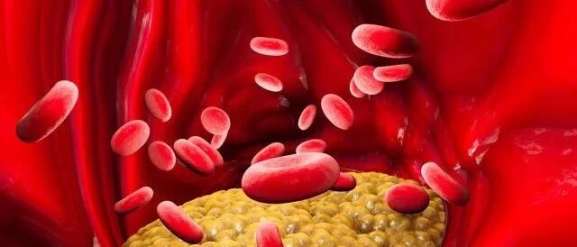 世界卒中日 | 脑卒中起病急、病死率高，预防关键点在这里！