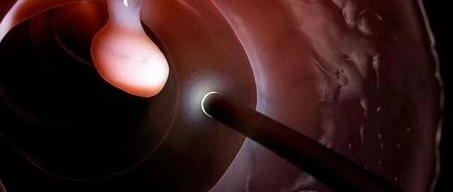 一次肠镜可保17年平安，这22类人尽快去做检查！