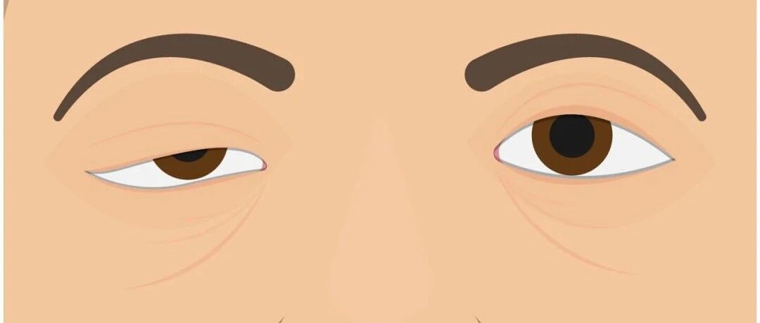 眼睑下垂、肌肉无力……重症肌无力是什么病？