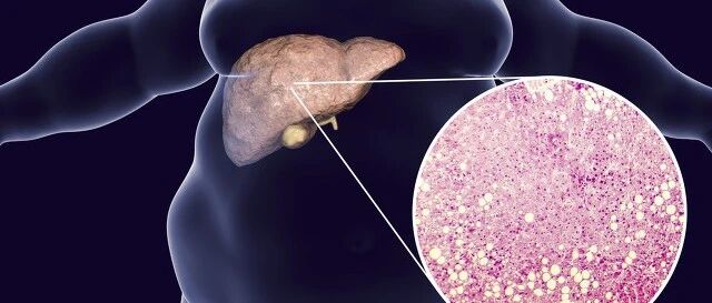 “脂肪肝不是病，只是一种亚健康状态”，这种观点正确吗？