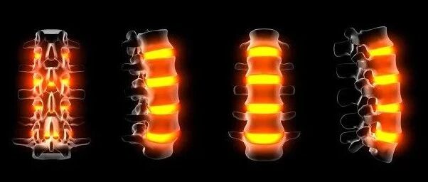 都是颈椎病，感觉不同，型号不一样！弄清楚自己是哪种​才能对症治疗！