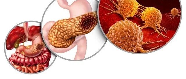 这六大人群易患胰腺癌，出现三大危险信号需要警惕！