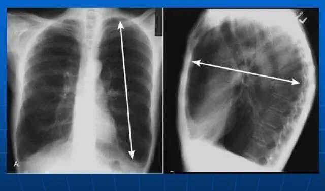 呼吸机怎么制氧慢阻肺患者｛制氧机还是呼吸机｝的选择_https://www.jmylbn.com_新闻资讯_第2张