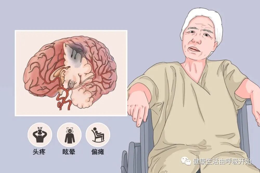 使用呼吸机为什么嗜睡睡眠呼吸机@治疗OSA优势_https://www.jmylbn.com_新闻资讯_第5张