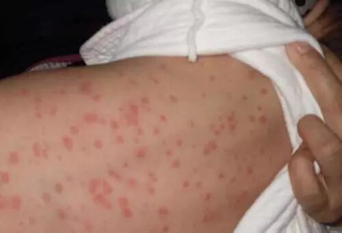 孩子过敏反复发作，元凶竟然是它？！