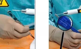 为什么手术用电刀手术中使用高频电刀原来还有这么多讲究，看看掌握了几点？_https://www.jmylbn.com_新闻资讯_第2张