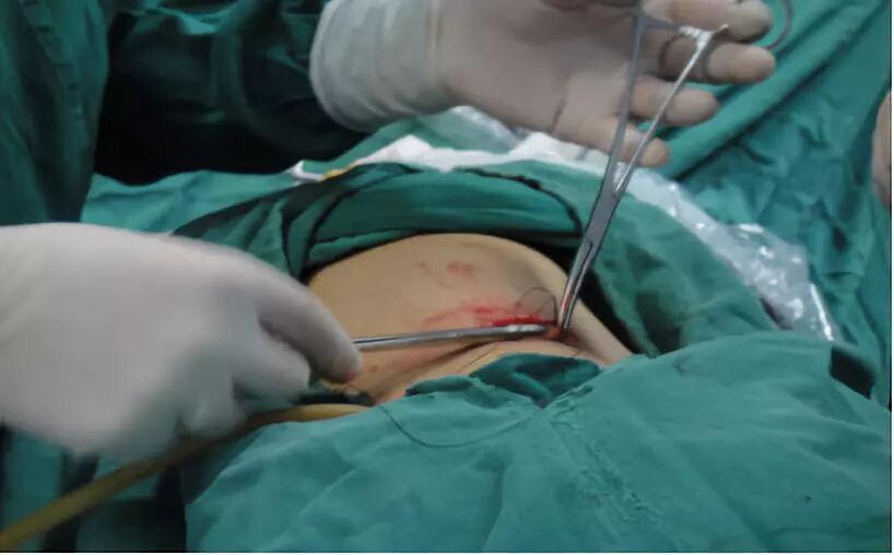 膀胱手术需要哪些器械腹腔镜下根治性膀胱切除术_https://www.jmylbn.com_新闻资讯_第8张