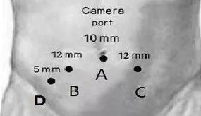 膀胱手术需要哪些器械腹腔镜下根治性膀胱切除术_https://www.jmylbn.com_新闻资讯_第6张