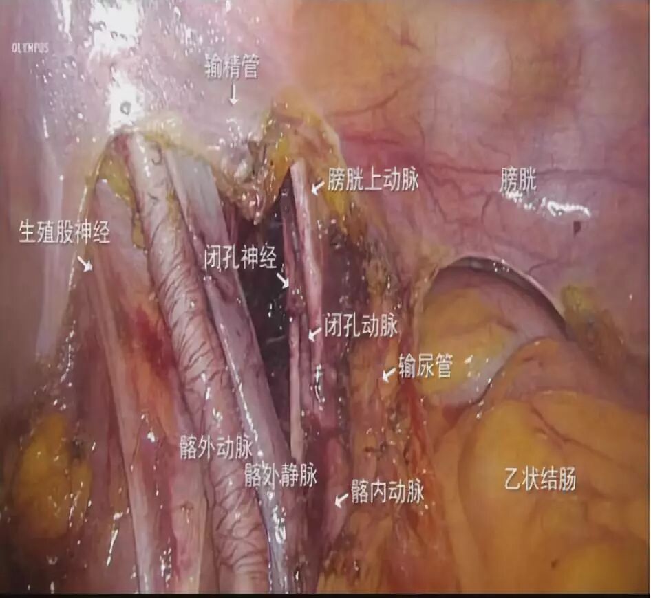 膀胱手术需要哪些器械腹腔镜下根治性膀胱切除术_https://www.jmylbn.com_新闻资讯_第7张