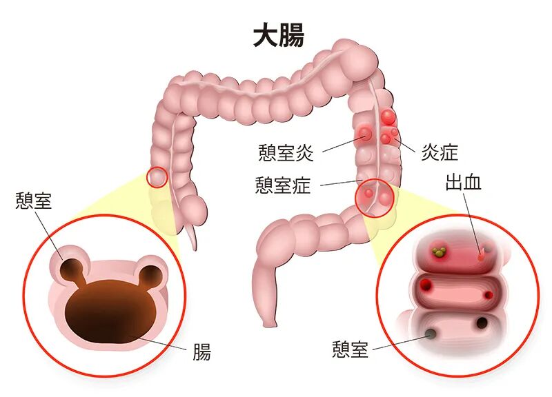 医学科普阅读 Diverticulitis憩室炎 医学英语学堂 微信公众号文章阅读 Wemp