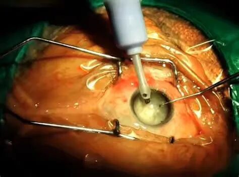 外伤性白内障:你不得不了解的相关知识!