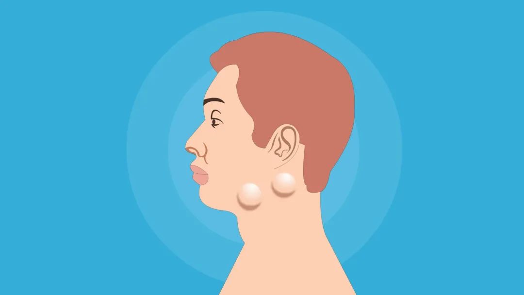 淋巴结肿大:炎症肿大或肿瘤转移?做啥检查?如何处理?