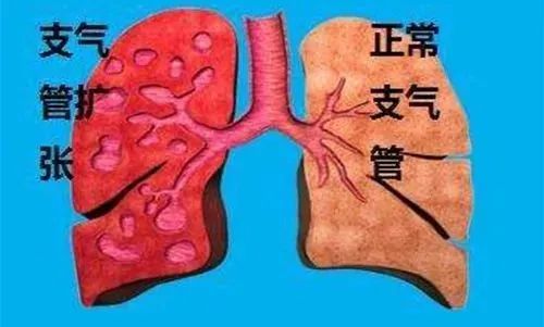 支气管扩张是常见的呼吸道疾病,常见的症状就是咳嗽,有的患者会在长期