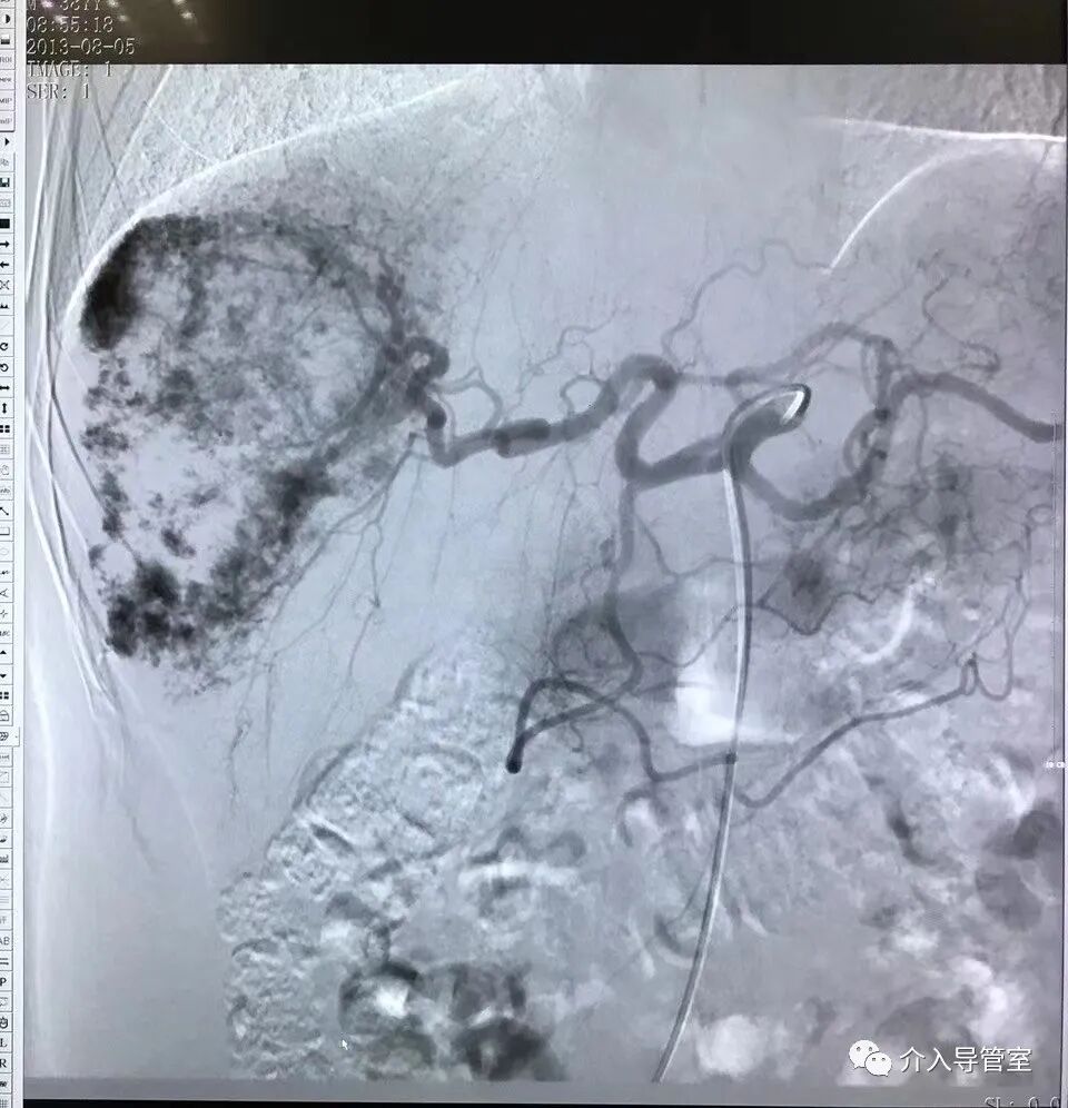 什么是外周介入【介入科普】介入治疗在外周血管疾病中地位不可替代_https://www.jmylbn.com_新闻资讯_第3张