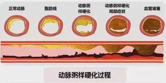 动脉硬化测什么【探究竟】动脉硬化检测是个啥检查_https://www.jmylbn.com_新闻资讯_第6张