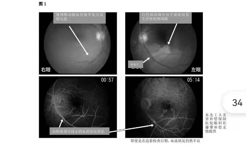 动脉硬化测什么【探究竟】动脉硬化检测是个啥检查_https://www.jmylbn.com_新闻资讯_第9张