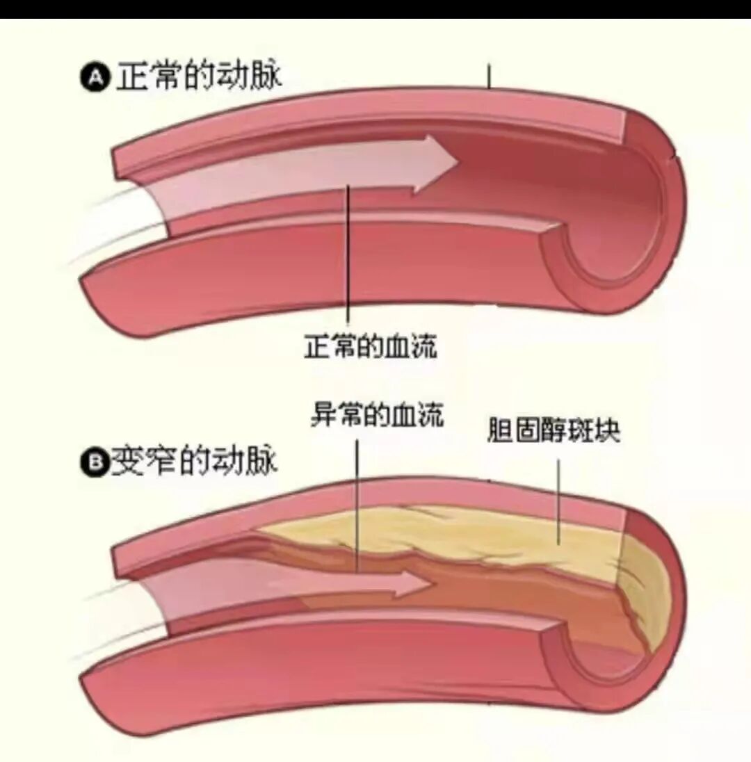 动脉硬化测什么【探究竟】动脉硬化检测是个啥检查_https://www.jmylbn.com_新闻资讯_第8张