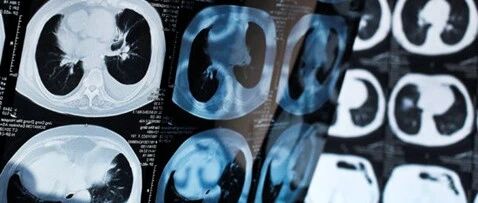 |第二建议|过继细胞疗法让转移性晚期肺癌患者获益(2)